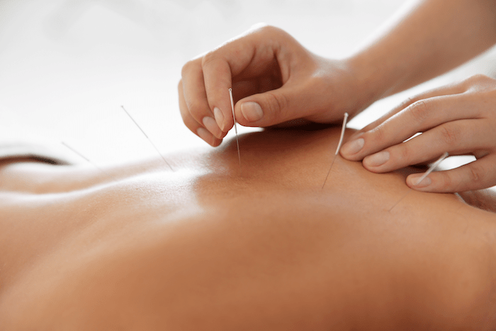 female medical acupuncture provider treating female patient