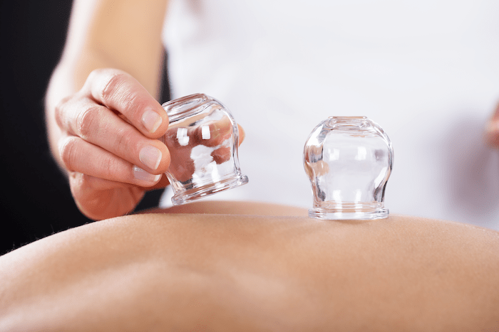 female cupping therapist treating male patient